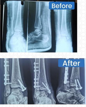 Successful Ankle Fracture Surgery by Dr. Ravi Krishna MS Ortho in Chidambaram