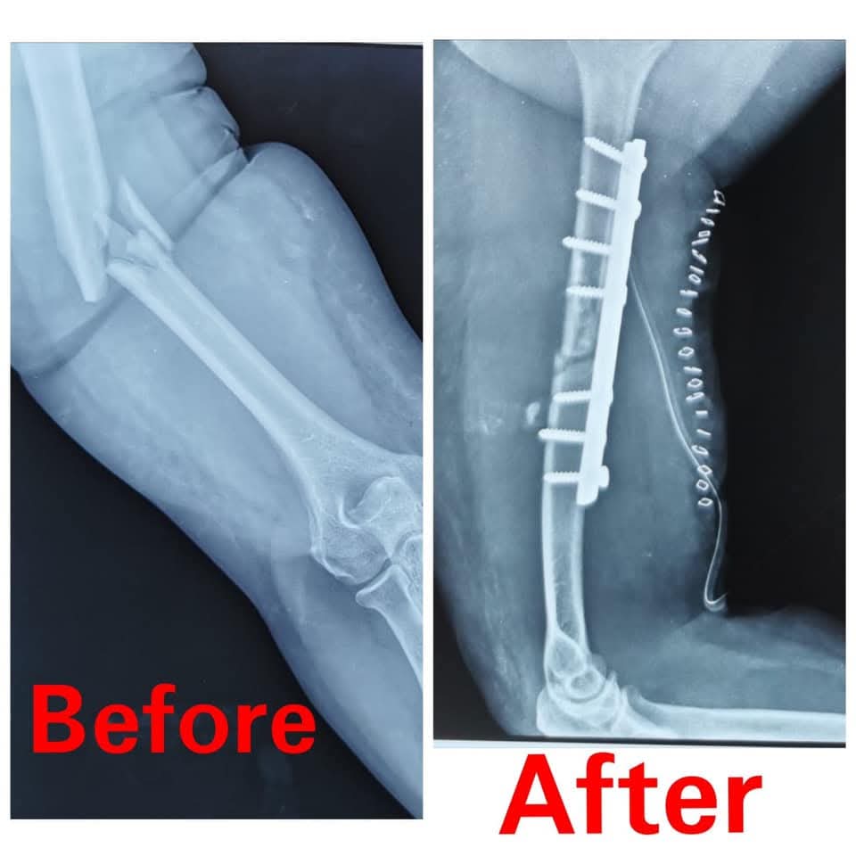 Successful Forearm Fracture Surgery by Dr. Ravi Krishna MS Ortho in Chidambaram