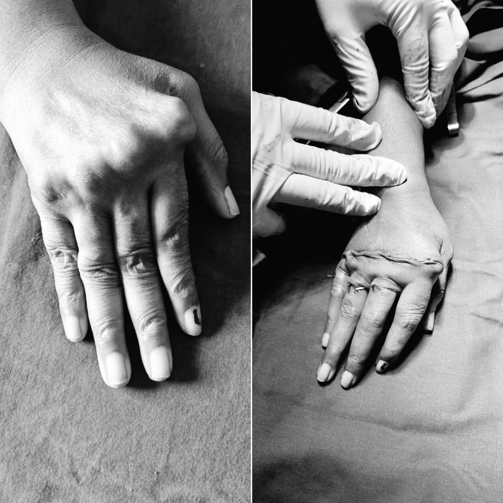 Hand Reconstruction Surgery by Dr. Ravi Krishna MS Ortho in Chidambaram