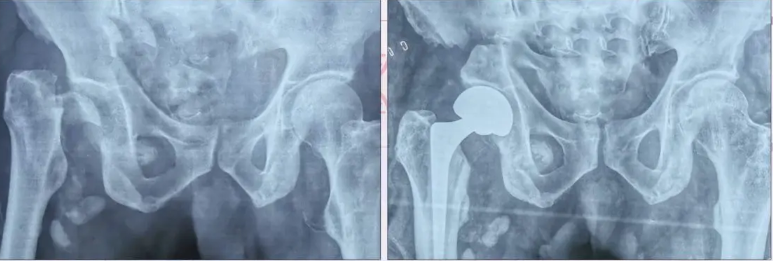 Successful Hip Surgery by Dr. Ravi Krishna MS Ortho in Chidambaram