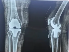 Successful Knee Surgery by Dr. Ravi Krishna MS Ortho in Chidambaram