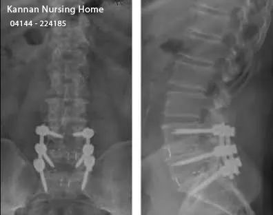 Lumbar Spine Stabilization Surgery by Dr. Ravi Krishna MS Ortho in Chidambaram