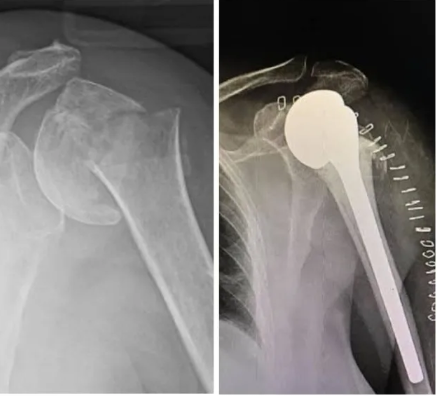 Shoulder Head Replacement Surgery by Dr. Ravi Krishna MS Ortho in Chidambaram